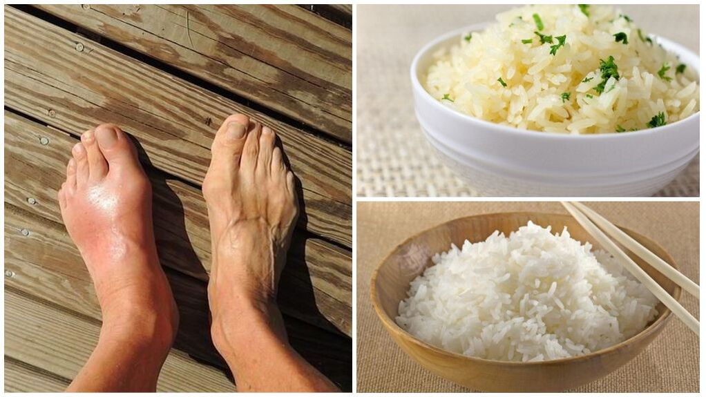 Pacientům s dnou se doporučuje dieta na bázi rýže. 